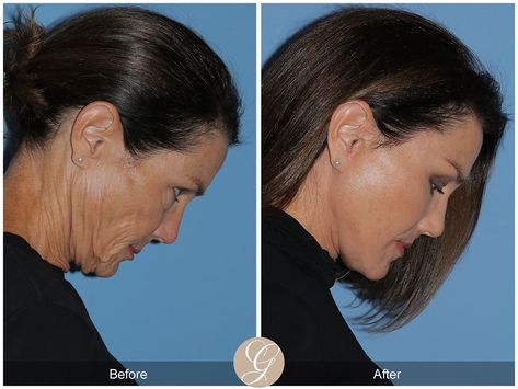 The Difference Between A Deep Plane Facelift & A SMAS Lift | Blog Deep Plane Facelift Before And After, Mini Face Lift Before And After, Mid Face Lift, Lower Face Lift, Deep Plane Facelift, Makeup For Over 60, Face Plastic Surgery, Neck Lift Surgery, Mini Face Lift