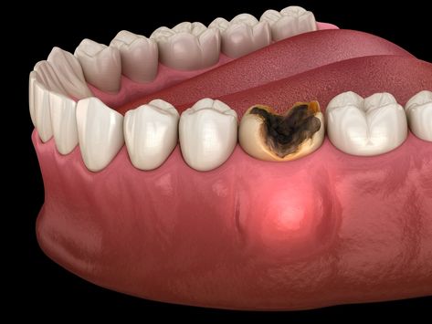 5 Stages Of An Abscessed Tooth & What To Do Tooth Abcess Remedy Home, Abcessed Tooth Remedy Swelling, Abcessed Tooth, Dental Abscess, Abscess Tooth, Tooth Nerve, Rotten Teeth, Teeth Remedies, Cracked Tooth