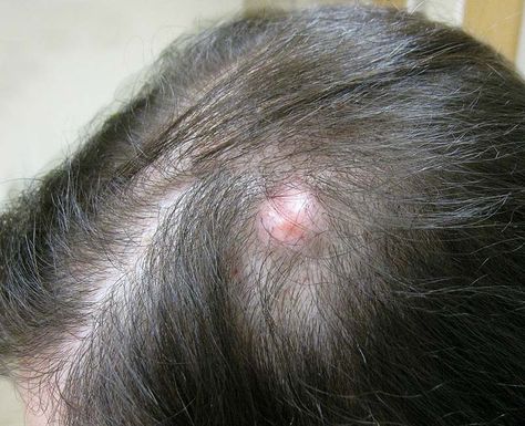 Pilar Cysts On Scalp, Sebaceous Cysts On Head Scalp, Essential Oils For Cysts, Bump On Head, Scalp Bumps, Infected Hair Follicle, Head Pimples, Skin Moles, Head Crown