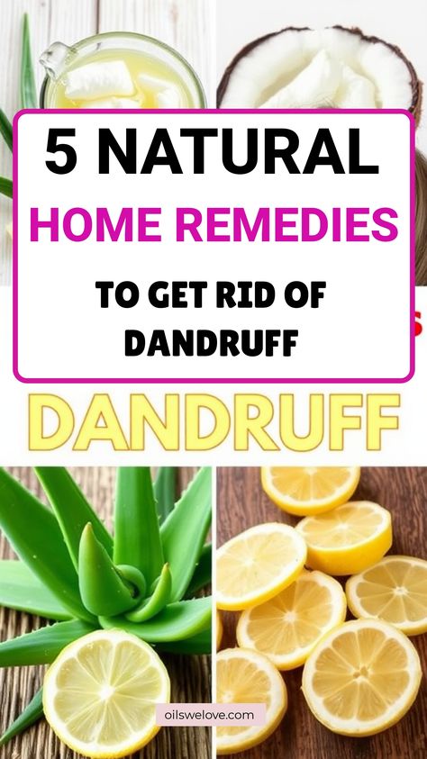 Natural remedies for dandruff with items like coconut oil, aloe vera, and lemon slices. Shampoo Black Hair, Juice For Hair, Baking Soda Dry Shampoo, Grow Hair Long, Baking Soda For Dandruff, Baking Soda Hair, Benefits Of Castor Oil, Baking Soda And Honey, Home Remedies For Dandruff