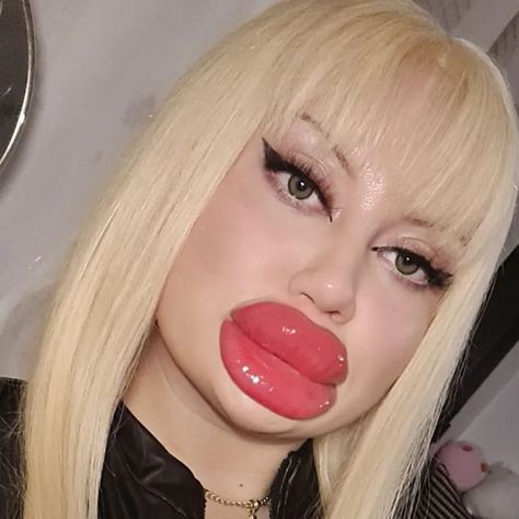 Huge Lip Fillers, Big Lips Funny, Bad Lip Filler, Big Lips Girl, Accepting Imperfection, Extreme Plastic Surgery, Art Pictures Ideas, Funny Lips, Female Lips