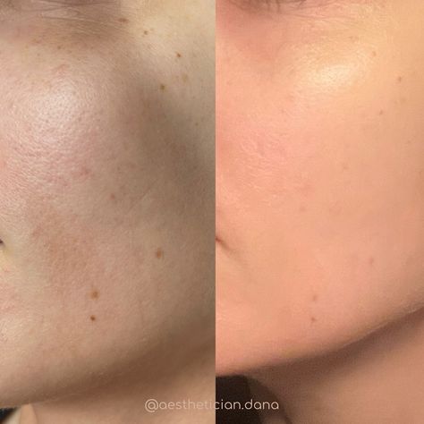 Mesotherapy Before And After, Hyperpigmentation Before And After, Skin Before After, Skin Before And After, Microneedling Before And After, Before After Skincare, Skinpen Microneedling, Before And After Acne, Professional Skincare