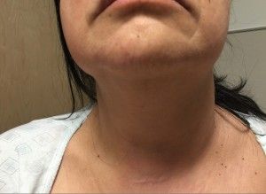 Very mild swelling of the left neck and  cheek Side Of Face, Stiff Neck, Diy Facial, Emergency Medicine, General Hospital, Ultrasound, Medicine, Facial, Skin