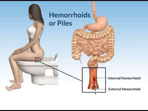 Hemorrhoid Removal, Alternative Treatments, Digestion Problems, Natural Home Remedies, Health Conditions, Natural Treatments, Health Problems, Womens Health, Natural Remedies