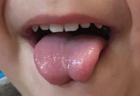 Tongue Tie: A Helpful Guide for Caregivers Feeding Therapy Activities, Feeding Therapy, Caregiver Resources, Why Questions, Laser Surgery, Sinus Congestion, Tongue Health, Tongue Tie, Lactation Consultant