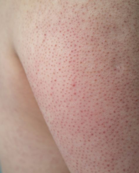 Will Keratosis Pilaris go away? The causes and treatments for Keratosis Pilaris • Illuminate Skin Clinics Body Skin Tightening, Anti Wrinkle Injections, Short Eyelashes, Oxygen Facial, Skin Tightening Face, Revision Skincare, Facial Contouring, Like Chicken, Keratosis Pilaris