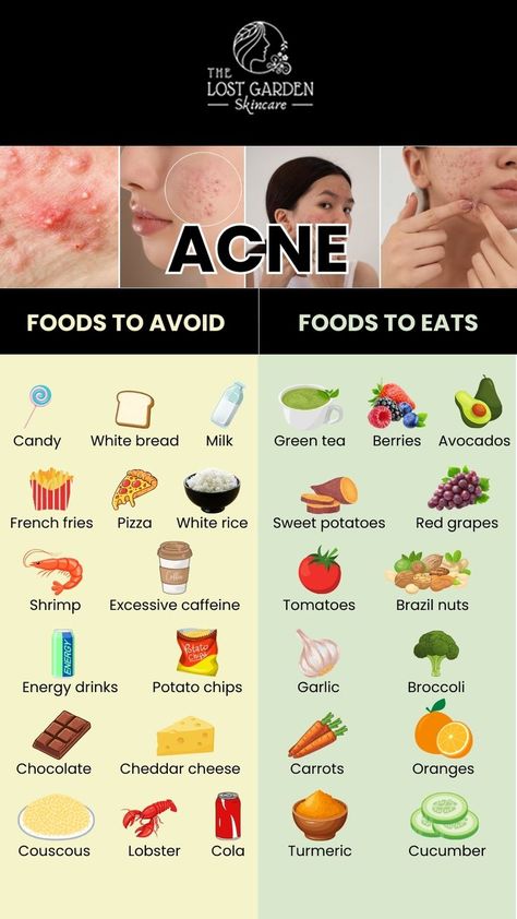 Want to fight acne through your diet? Find out the foods you should avoid and the ones you should include for healthier, acne-free skin. Visit our online shop for acne-fighting products and achieve clear skin! Food For Acne, Foods For Clear Skin, Clear Skin Diet, Acne Diet, Skin Diet, Acne Free Skin, Clear Healthy Skin, Natural Acne, Makanan Diet