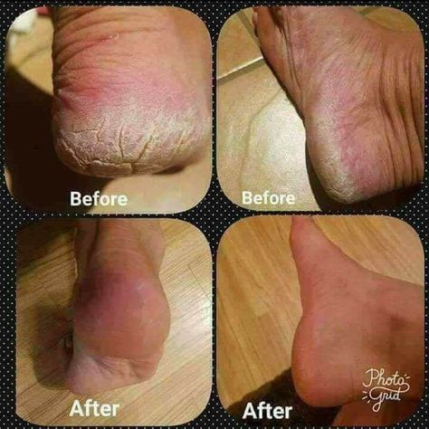 OMG...you guys!!!😮😮😮 You HAVE to check out these before & after pictures!!! 😍😍😍 These are my friend's results after using the Epoch Sole Solutions for 3 weeks using it 1-2 times a day!!😍 Her heels would always get extremely cracked from winter ❄and regular lotions and things wouldn't do much justice🚫 but omg!! 😮This cream has almost COMPLETELY healed her feet!!😍😍😍 If you deal with dry, damaged feet at any level of severity then PLEASE message me so your results can be as amazing as m Epoch Sole Solution, Dry Cracked Heels, Foot Nail, Pain Relief Cream, Foot Pain Relief, Athletes Foot, Cracked Heels, Cracked Skin, Nail Fungus