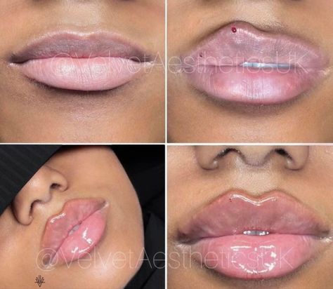 Lip Job, Heart Shaped Lips, Natural Botox, Lips Inspiration, Face Fillers, Botox Lips, Beauty Procedures, Lip Augmentation, Pride Makeup