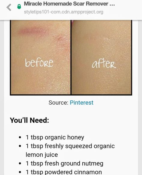 oral care routine Scar Fading Remedies, Scar Healing Stages, How To Remove Scars On Legs Fast, Scar Removal Diy, How To Heal Scars, Burn Scar Removal, Scar Healing Remedies, How To Fade Scars, Scar Healing