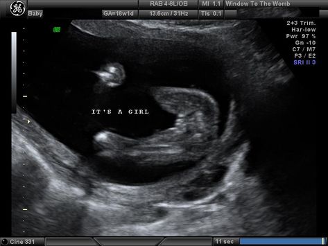 2d ultrasound its a girl Girl Ultrasound, Sonography Aesthetic, Ultrasound Anatomy, Ultrasound Sonography, School Needs, Ultrasound Pictures, 16 Weeks, Its A Girl, Normal Girl