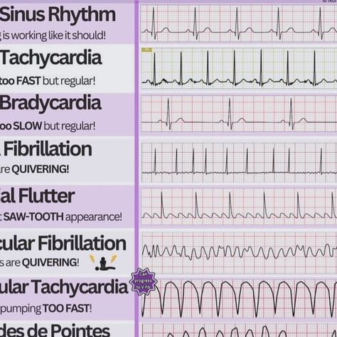 Surajit Tripura on Instagram: "Heart Rhythm | Health Sector" Heart Rythym Chart, Heart Rhythm Nursing Cheat Sheets, Irregular Heart Rhythms, Ekg Rhythms, Nursing Cheat Sheet, Nurse Study, Nursing Cheat, Heart Rhythm, Nurse Study Notes