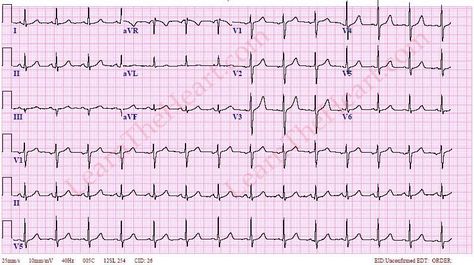 Normal Ecg, Ecg Interpretation, High Potassium, Heart Rhythm, Heart Rhythms, Time Table, Joker Wallpapers, Study Help, Abdominal Pain