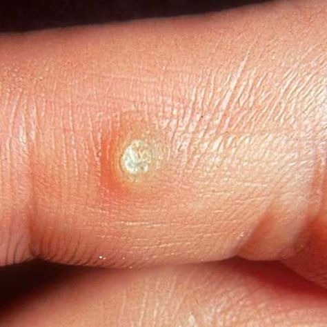 Warts Pictures: Thick Wart on Finger Natural Wart Remedies, Wart On Finger, Warts On Hands, Home Remedies For Warts, Warts Remedy, Get Rid Of Warts, Homeopathic Remedies, Natural Home Remedies, Homeopathy