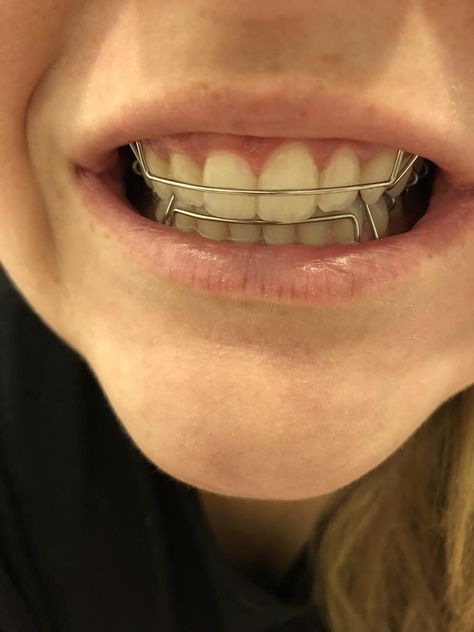 Braces Problems, Hawley Retainer, Braces Retainer, Retainer Teeth, Cute Braces Colors, Adult Braces, Braces Girls, Cute Braces, Long Natural Nails