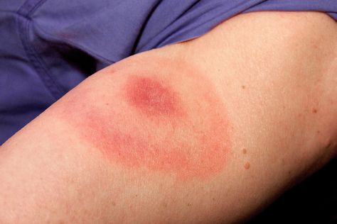 Bug Bites Pictures: Identifying Bugs and Bug Bites Spider Bites Pictures, Recluse Spider Bite, Poisonous Spiders, Recluse Spider, Brown Recluse Spider, Bad Bugs, Tick Bite, Tick Repellent, Spider Bites