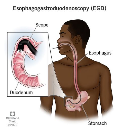 Endoscopy Procedure, Macon Georgia, General Anaesthesia, Feeling Sleepy, Gi Tract, Med Surg, Vital Signs, Stomach Acid, Medical Office