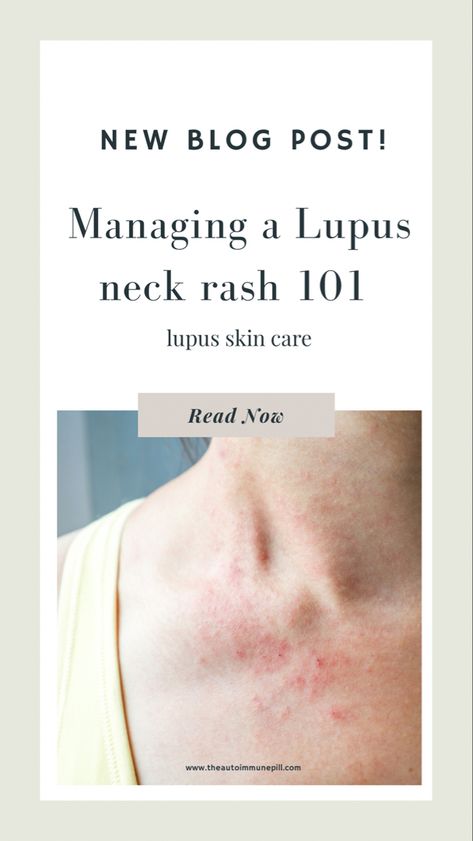 Managing a lupus neck rash Neck Rash, Rash On Neck, Types Of Rashes, Skin Symptoms, Autoimmune Disorders, Home Remedies For Skin, Auto Immune, Skin Burns, Trial And Error