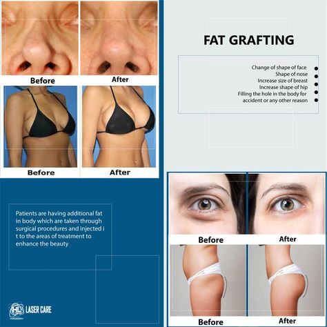 Fat Grafting Breast, Fat Grafting, Mommy Makeover, Womens Health, Surgery, Skin, Beauty