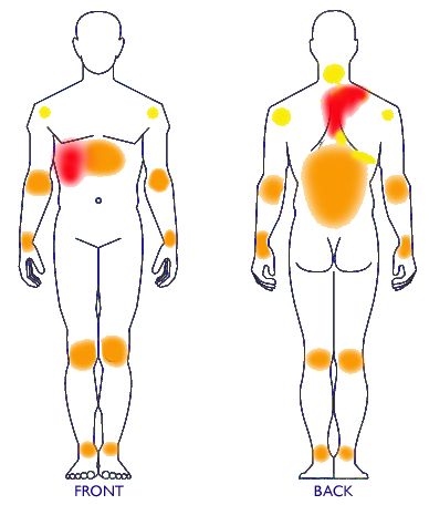 Gallbladder Symptoms | Muscular and joint pains associated with #gallstone conjestion. Gallbladder Attack Diet, Gallbladder Stones Diet, Gallbladder Symptoms, Gallstone Diet, Gallbladder Flush, Gallbladder Attack, Gallbladder Cleanse, Gallbladder Stones, Gallbladder Diet