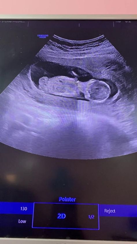 12 weeks ultrasound, Can anybody know if you can see the gender? thanks | By Bk Bullieskennel - Facebook 12 Week Ultrasound, Baby Mommy, 12 Weeks, Ultrasound, Canning, Quick Saves