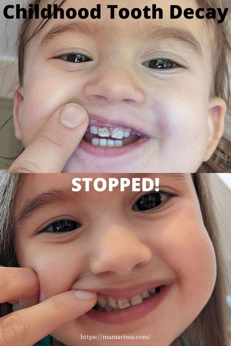 #PreventiveOralHealthCare Toddler Cavities, Cavity Remedy, Remineralize Teeth, Cavities In Kids, Remineralizing Toothpaste, Toddler Tooth Decay, Baby Tooth Decay, Tooth Cavity, Tooth Decay Remedies