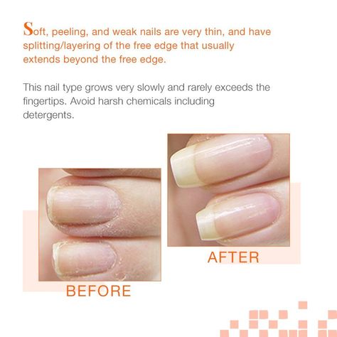 how to keep nails healthy Prep Nails, Nail Remedies, Peeling Nails, Nail Tek, Botox Face, Weak Nails, Nail Type, Nail Products, Nail Strengthener