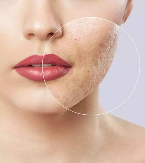 Types Of Acne Scars And How To Treat Them Naturally At Home Best Acne Scar Removal, Hypertrophic Scars, Antiaging Skincare Routine, Acne Scar, Types Of Acne, Acne Scar Removal, Skin Resurfacing, Laser Skin, Face Acne