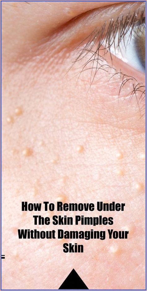 How To Remove Under The Skin Pimples Without Damaging Your Skin Pimple Meaning, Under The Skin Pimples, Hair Dye Removal, Blind Pimple, Pimples Under The Skin, How To Reduce Pimples, Skin Natural Remedies, Under The Skin, Acne Cream