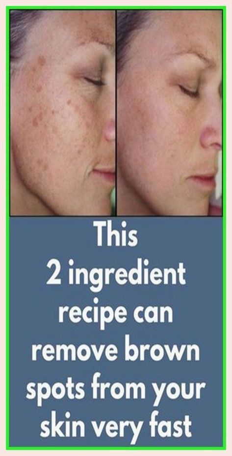 This is a Splendid info! Dark Patches On Skin, 2 Ingredient Recipes, Face Treatments, Brown Spots On Skin, Spots On Skin, Wrinkle Remedies, Dark Spots On Face, Skin Hyperpigmentation, Brown Spots Removal