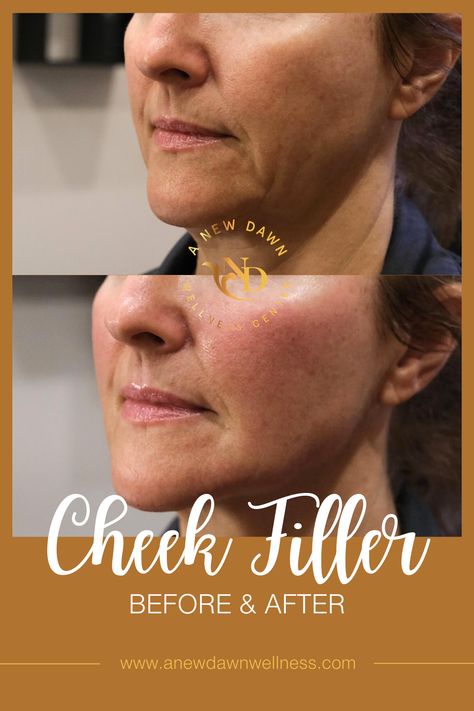 Cheek Filler Before & After from A New Dawn Wellness Center in Scottsdale, AZ Natural Cheek Filler, Cheek Filler Placement, Cheekbone Filler Before And After, Cheek Fillers Before And After Face, Cheek Injections, Nasolabial Folds Dermal Fillers, Facial Symmetry Filler, Jaw And Cheek Filler, Medial Cheek Filler