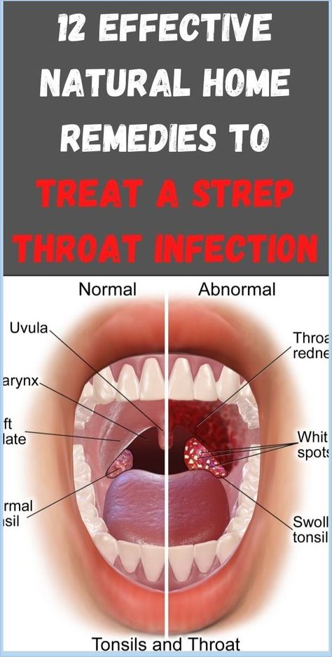 12 Effective Natural Home Remedies To Treat A Strep Throat Infection Strep Throat Symptoms, Strep Throat Remedies, Throat Remedies, Throat Infection, Strep Throat, Organic Remedy, Healthy Advice, Healthy Teas, Preventative Health