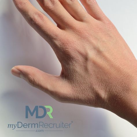 Many people experiencing dry, scaly skin on their hands and deep, painful cracks in their fingers aren’t aware that what they could be dealing with is hand eczema.   Find out more about the difference between dry skin and hand eczema in this article from the AAD today! Rash On Hands, Dry Scaly Skin, Dry Skin Makeup, Scaly Skin, Dry Skin Care, Best Moisturizer, Skincare Tips, Dehydrated Skin, Skin Tips