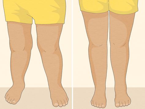 How to Fix Knock Knees: 12 At-Home Methods