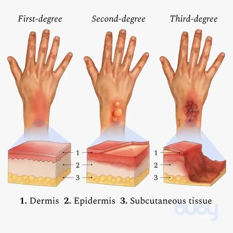 Types Of Burns, Degree Burns, Severe Burns, Subcutaneous Tissue, Nursing Student Tips, Tattoo Cover-up, Layers Of Skin, Medical School, Nursing Students