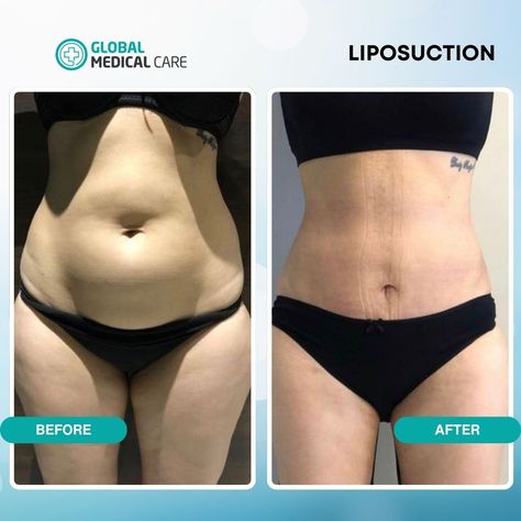 Another amazing before-and-after result from our liposuction procedure! 💪    At Global Medical Care, we’re here to help you achieve the body you’ve been dreaming of with safe, effective, and personalized treatments. 🌟  Individual results and potential risks may vary. All images provided by licensed doctors. Consult with a healthcare professional for personalized advice.      📞 For a free consultation, contact us at +44 20 3936 5565   #liposuction #liposuctionturkey Dercums Disease, Improve Body Image, Eyebrow Transplant, Beard Transplant, Dental Veneers, Dental Crowns, Scarring, Fat Removal, Breast Augmentation