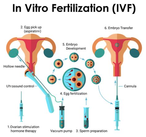 What is IVF (In-Vitro Fertilization)? | The Process, Success Rate, Side Effects, and Risk Factors Ivf Success Stories, Fertilization Process, Invitro Fertilization, Ivf Procedure, Ivf Cost, Sperm Donor, Ivf Cycle, Embryo Transfer, Ivf Success