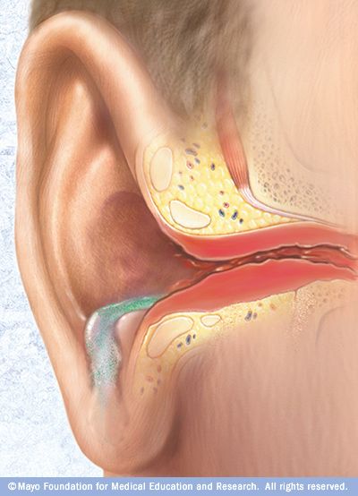 Redness of the ear canal, draining fluids and discharge of pus are signs of swimmer's ear (otitis externa). Untreated, the infection can spread to nearby tissue and bone. Ringing Ears Remedy, Swimmers Ear, Sinus Infection Remedies, Ear Ache, Canker Sore, Natural Detergent, Sinus Infection, Natural Home Remedies, Swimmers