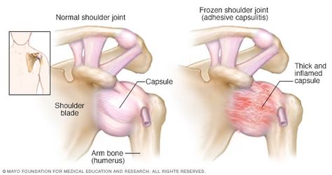 What Is Frozen Shoulder, Frozen Shoulder Pain, Sleeping Problems, Frozen Shoulder, Cleveland Clinic, Scar Tissue, Trigger Points, Mayo Clinic, Shoulder Pain