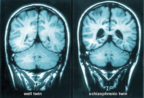 What Causes It?  Scientists don’t know the cause. A person’s genes, experiences, and setting may all be involved. Theories include how active and how well certain areas of the brain work, as well as problems with brain chemicals such as dopamine and glutamate. There may be structural differences, too, like loss of nerve cells that result in larger fluid-filled cavities or "ventricles” in the brain. Brain Scan Aesthetic, Brain Scans, Mri Brain Scan Image, Brain Waves Neuroscience, Brain Scan Neuroscience, Boston Childrens Hospital, Health Images, Brain Images, Brain Structure