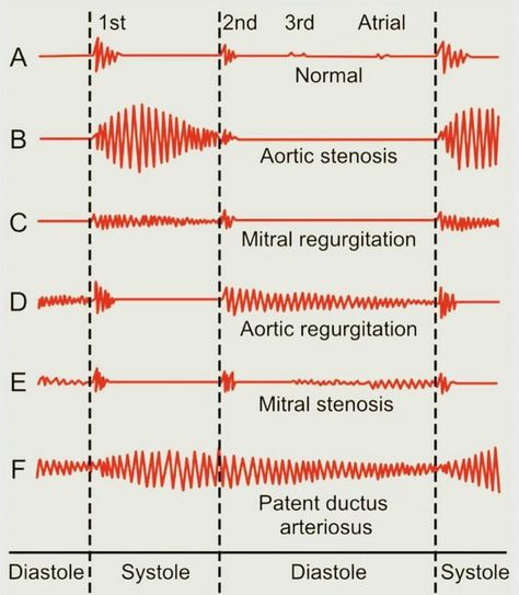 Patent Ductus Arteriosus, Mitral Valve, Heart Sounds, Cardiac Nursing, Nursing School Survival, Medical School Studying, Nursing Tips, Emergency Medicine, Nursing Notes