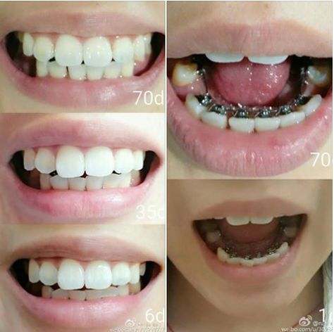 Bravo! the 1st day to the 70th day! A freshly updated sharing of teeth progress from ebrace patients #orthodontists #braces Lingual Braces, Dental Braces, 1st Day, Braces, Beauty Tips, Beauty Hacks, Beauty