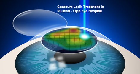 Advanced technologies are created in the healthcare field to make the life of patient more comfortable and healthier. Technological advancements are a must in this field because many patients are not able to get the benefit of the technologies available in the industry. Such patients either suffer from altogether new disease or the disease is gone into an advanced stage and is not being treated with the current system of medications and surgery. Cornea Eye, Eye Examination, Laser Vision Correction, Eye Conditions, Lasik Eye Surgery, Laser Vision, Eye Surgeon, Laser Eye Surgery, Lasik Surgery