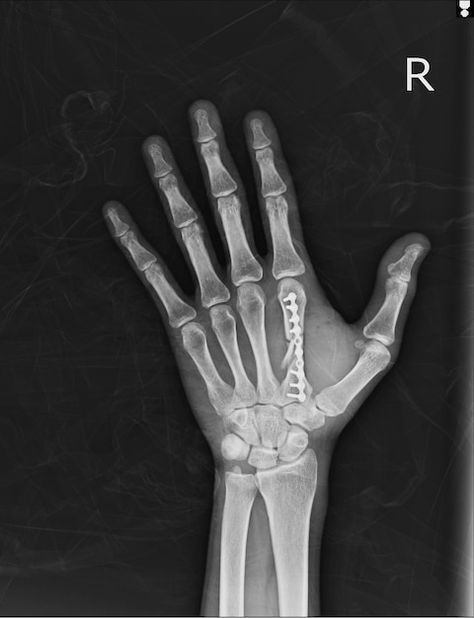 Mano de rayos x ap, oblique: fijar el se... | Premium Photo #Freepik #photo #dolor-huesos #huesos-humanos #cuerpo-humano #ortopedista Human Muscle Anatomy, Muscle Anatomy, Radiology, X Ray, Premium Photo, The Internet, Ipad, Mural, Books