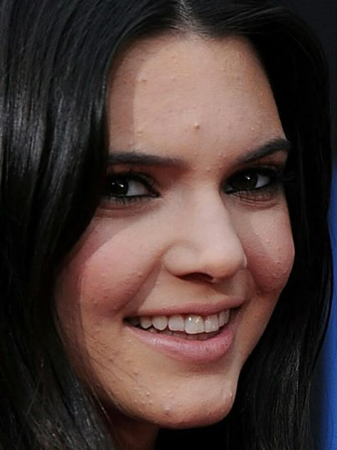 Girl With Acne, Kendall Jenner Icons, Flip Watch, Celebrity Acne, Skin Advice, Skin Aesthetics, Celebrity Skin, Hair Bun Tutorial, Face Acne