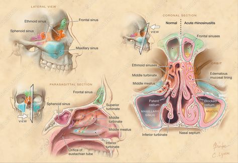 Alison Burke  Anatomy of Paranasal Sinuses and Nasal Passages  © American Medical Association  #medical #illustration #anatomy Maxillary Sinus Anatomy, Paranasal Sinuses Anatomy, Sinus Anatomy, Illustration Anatomy, Paranasal Sinuses, Maxillary Sinus, Nasal Septum, Gross Anatomy, Nasal Passages