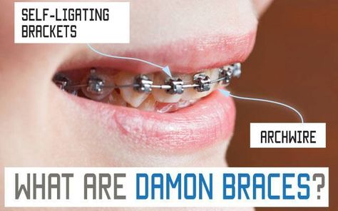 Damon Braces or Traditional Metal Orthodontic Braces? Braces Before And After, Damon Braces, Adult Braces, Orthodontics Braces, Patient Education, Braces, Education