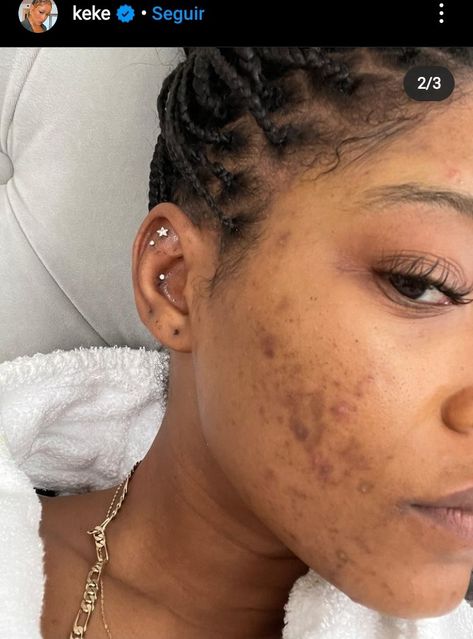 Acne Photos, Girl With Acne, Acne Women, Natural Acne, Types Of Acne, Acne Causes, Simple Skincare Routine, Keke Palmer, Bare Beauty