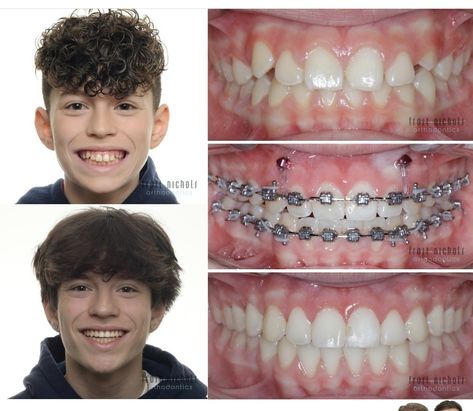 Types Of Braces, Getting Braces, Cute Braces, Braces Colors, Dental Braces, Orthodontics Braces, Beauty Tips For Glowing Skin, Black Kids Hairstyles, Tooth Fairy