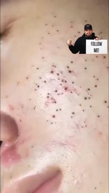 #pimple #ingrownhair #pinplepopper #beard #acne #squeeze #squeezeyuk #pimple #blackhead #blackheadsremoval Black Heads On Nose, Head Pimples, Squeezing Blackheads, Nose Pimples, Pimple Popper Tool, To Remove Pimples, Cystic Pimple, Kids Skin Care, Remove Pimples